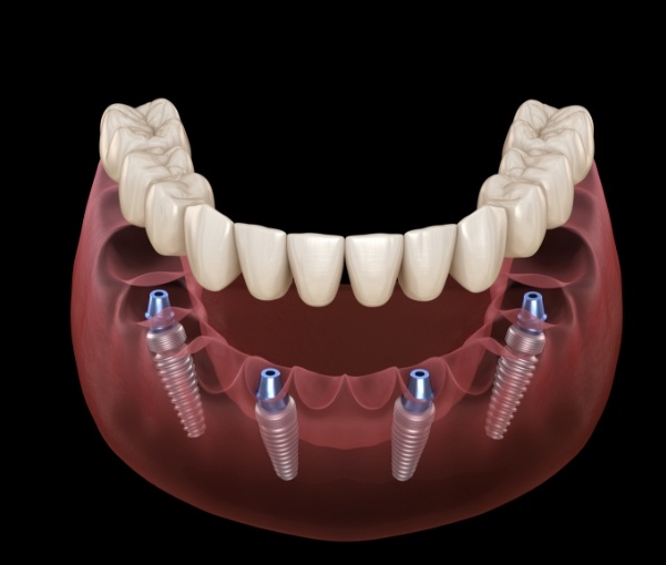Illustrated model of All on 4 dental implants in New York