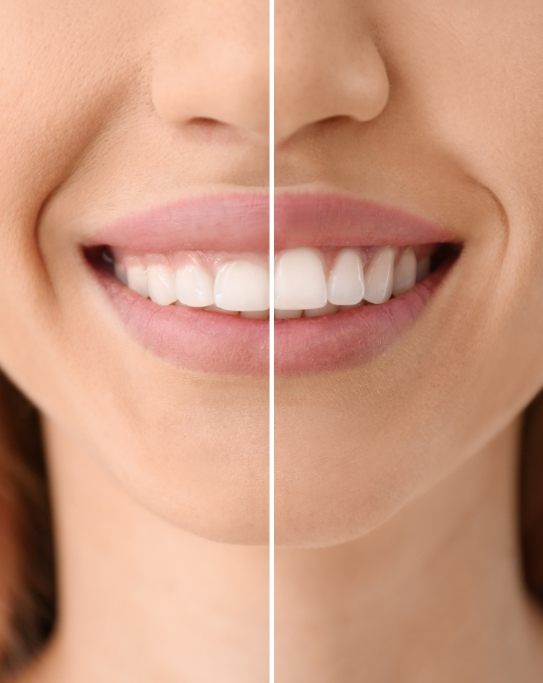 Close up of smile before and after gummy smile correction