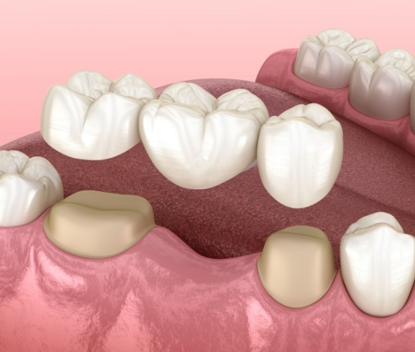 Illustrated dental bridge being placed to replace a missing tooth