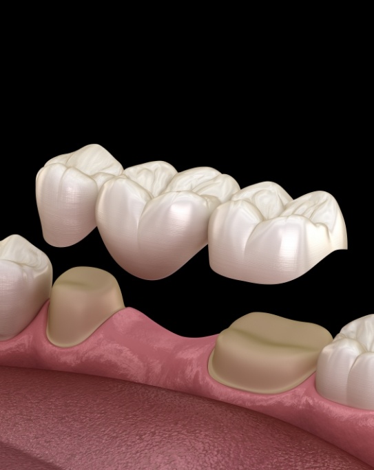 Illustrated dental bridge replacing a tooth
