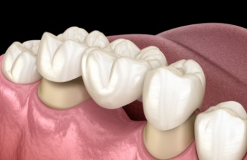 Traditional dental bridge being supported by two natural teeth