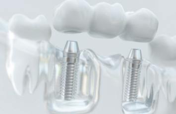 Model of mouth with dental bridge supported by two dental implants