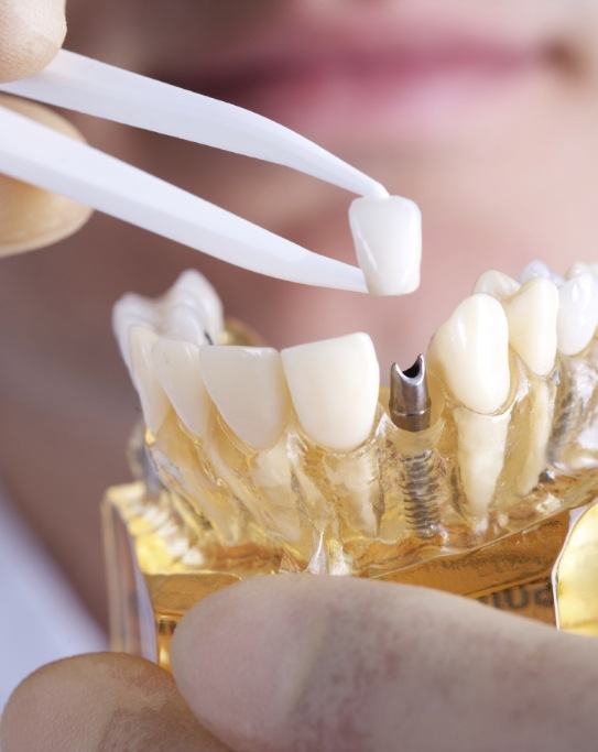 Dentist placing a crown over a dental implant model