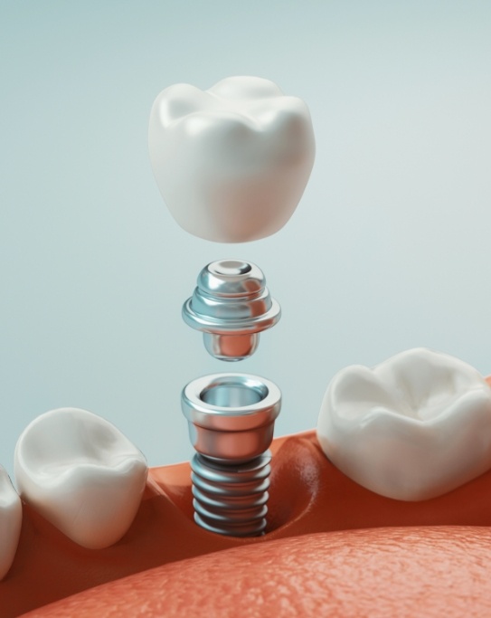 Illustrated dental implant with crown and abument being placed in lower arch