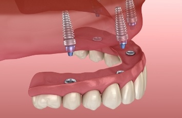 Illustrated upper denture being fitted over four dental implants