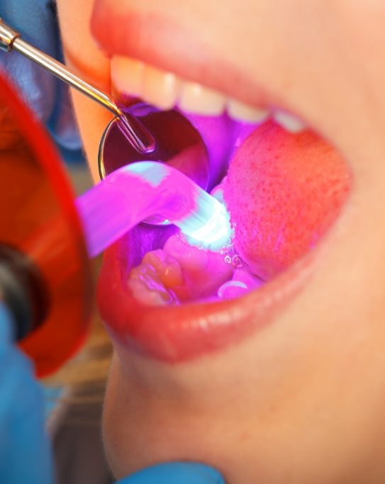Close up of dental patient getting tooth fixed with direct bonding