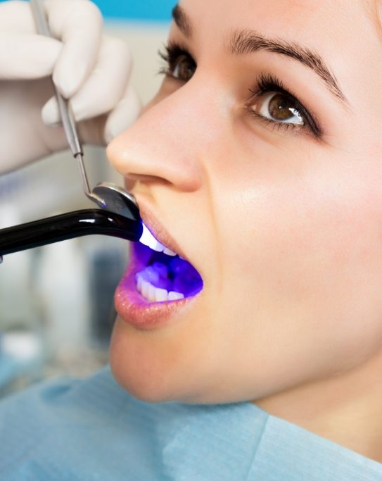 Woman getting direct bonding on front upper tooth