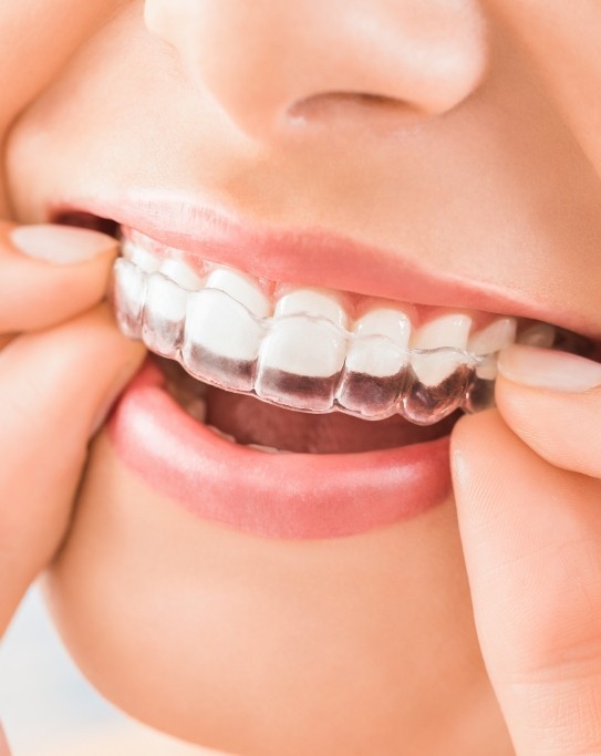 Close up of person placing an Invisalign aligner over their teeth