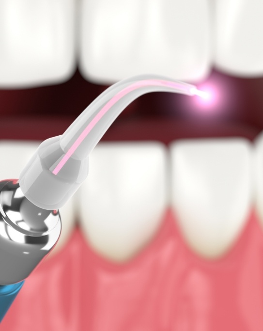 Illustrated dental laser in front of an open mouth