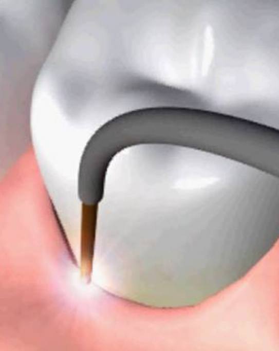Close up of illustrated dental laser treating the gums
