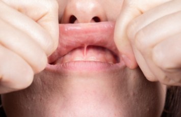 Close up of person stretching their upper lip upwards