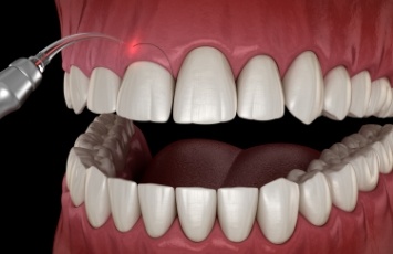 Illustrated dental laser adjusting the gumline