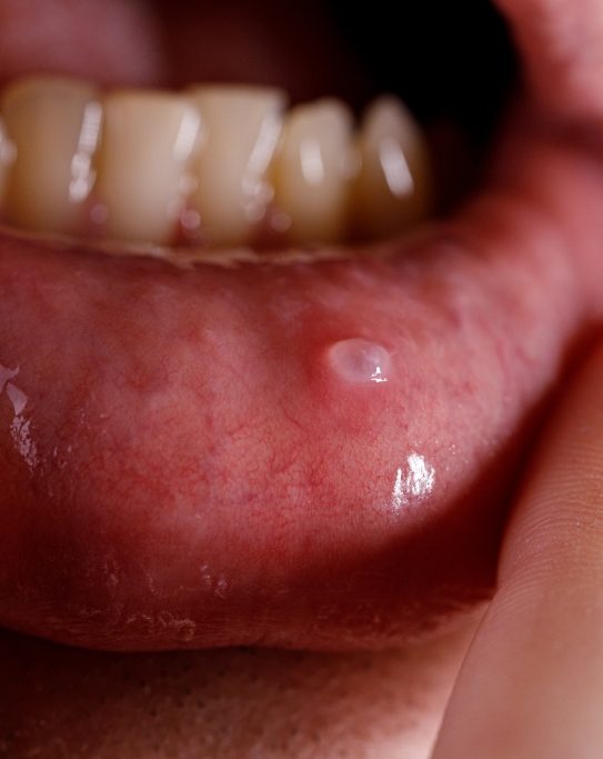 Close up of mouth with small bump on lip