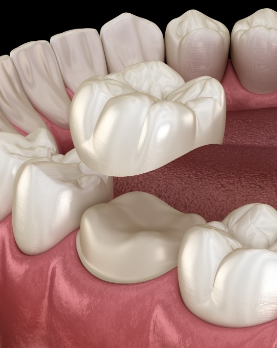 Illustrated dental crown covering a tooth