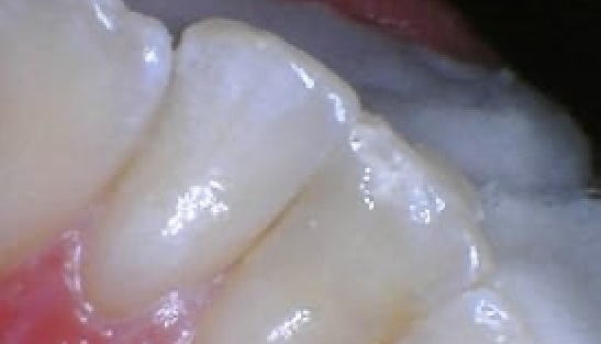 Close up of white tooth after dental bonding
