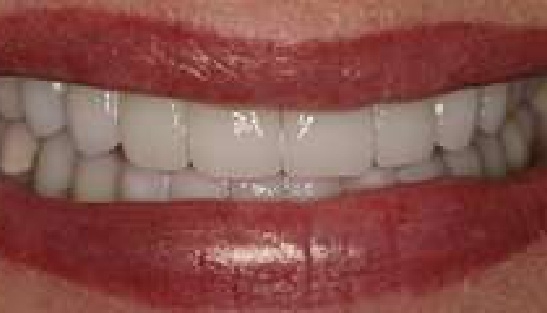Close up of mouth after correcting chipped teeth