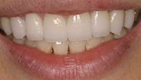 Smile with whiter and more well aligned teeth