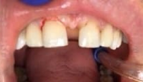 Mouth after fixing damaged teeth