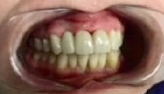 Mouth after replacing missing upper tooth