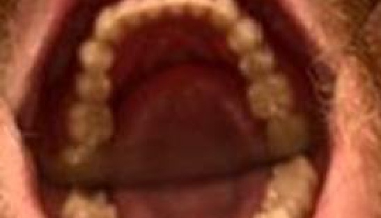 Arch of well aligned teeth 