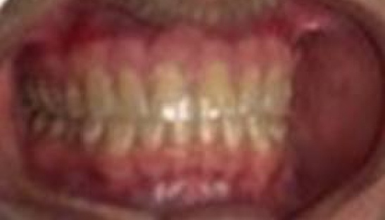 Mouth after gum treatment