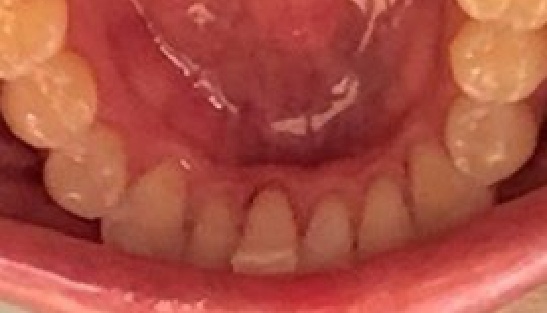 Arch of aligned teeth