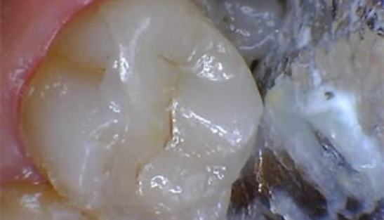 Tooth with new ceramic dental crown