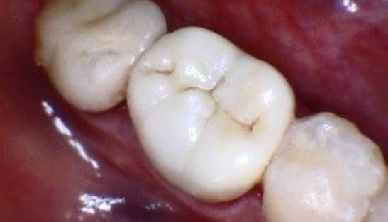 Tooth after replacing metal filling with ceramic dental crown