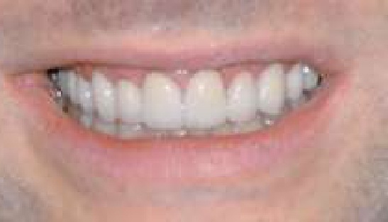 Man smiling with much whiter teeth