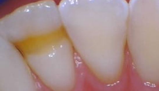 Close up of tooth with stain before dental bonding