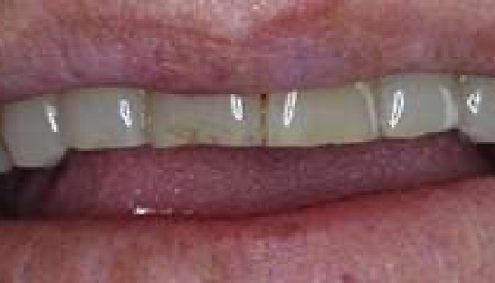 Mouth with chipped teeth before dental treatment