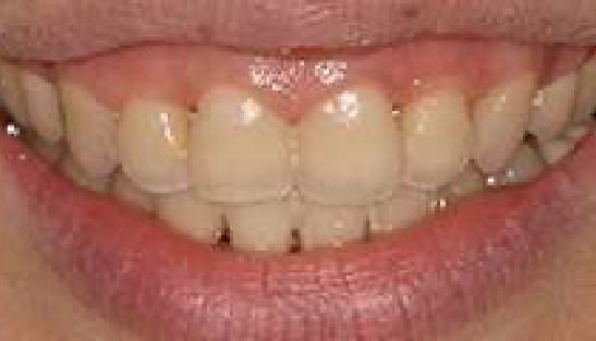 Smile with stained and misaligned teeth