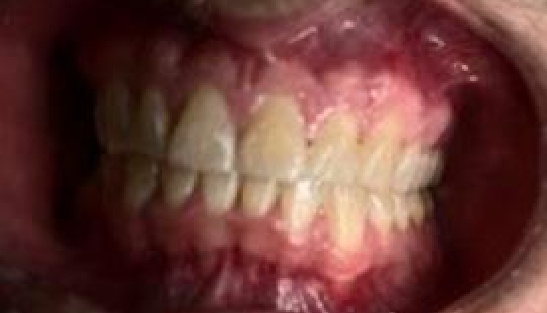 Mouth before gum treatment