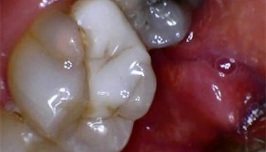 Tooth with old metal dental crown
