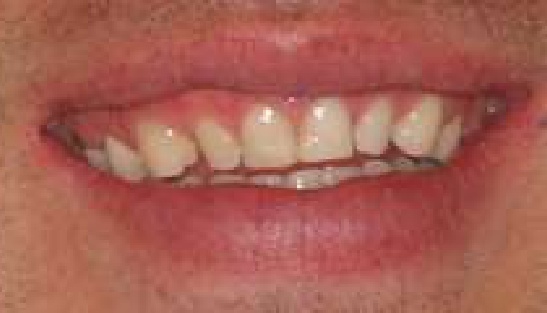 Close up of smile before dental treatment