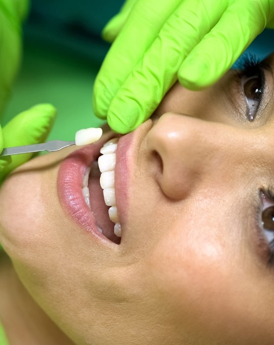 Woman having a veneer being placed over her tooth