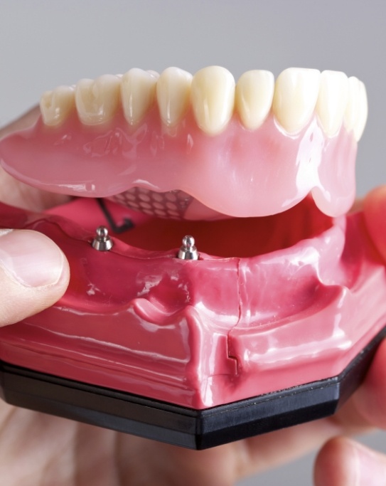 Hand holding an implant denture model