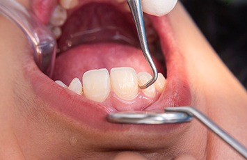 A smile receiving scaling and root planing