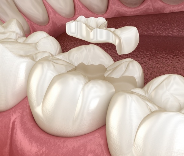 Illustrated dental inlay being placed onto a damaged tooth