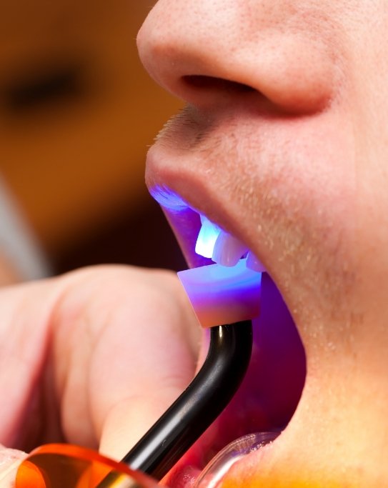 Close up of dental patient getting direct bonding on front upper tooth