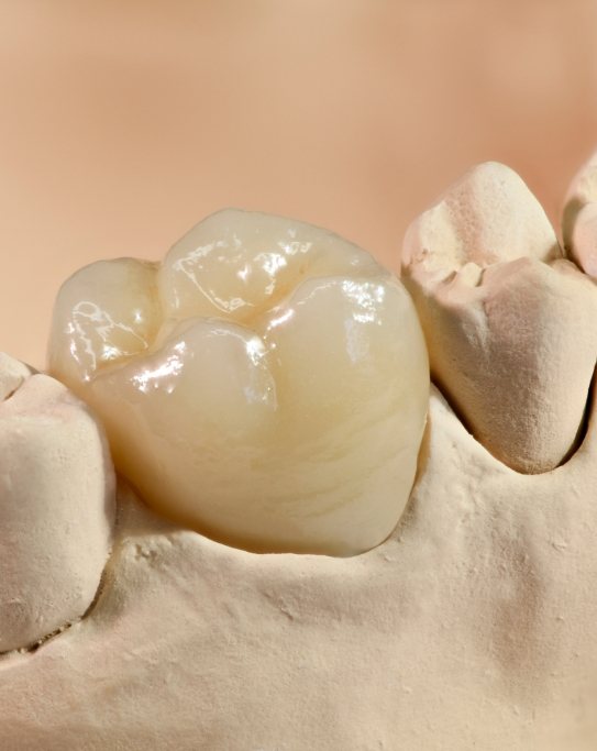 Dental crown covering a tooth in a model of the mouth