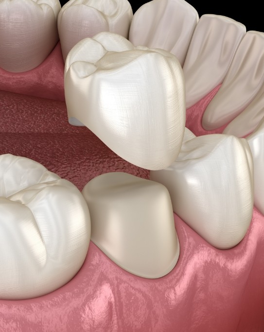 Illustrated dental crown being fitted over a tooth