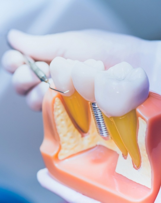 Dentist holding a model of a dental implant in the jaw