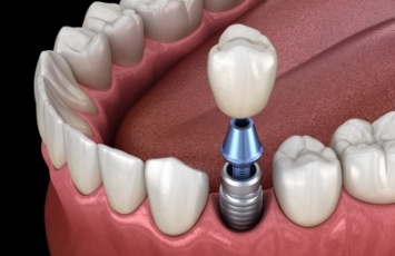 Illustrated dental crown being fitted onto a dental implant