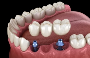 Illustrated dental bridge being fitted onto two dental implants