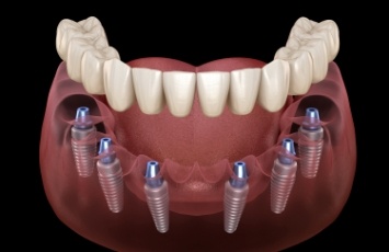 Illustrated full denture being fitted onto six dental implants