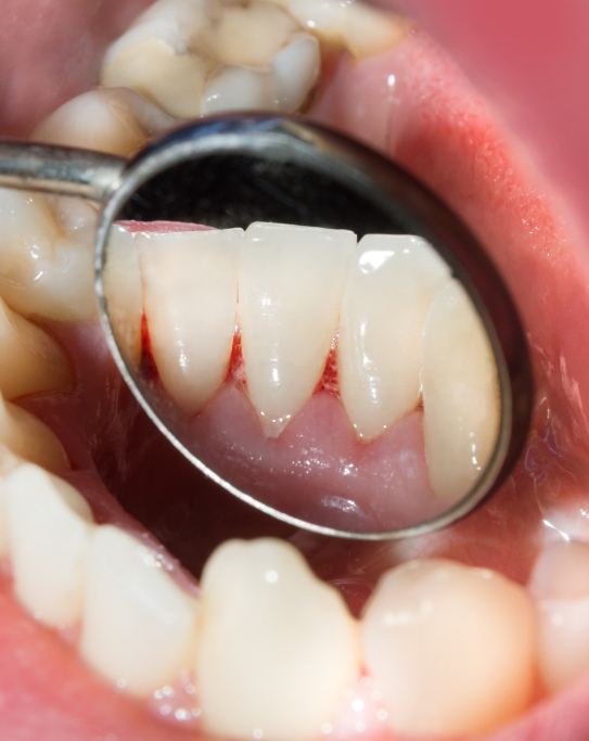 Close up of dental mirror inside of mouth