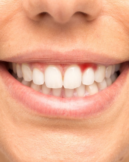 Close up of person smiling with red spot in the gums