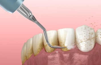 Illustrated dental scaler clearing plaque buildup from teeth