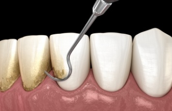 Illustrated dental scaler removing plaque buildup from teeth